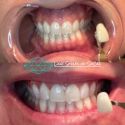 Luxe Smiles of SoCal - Before/After 60 minutes