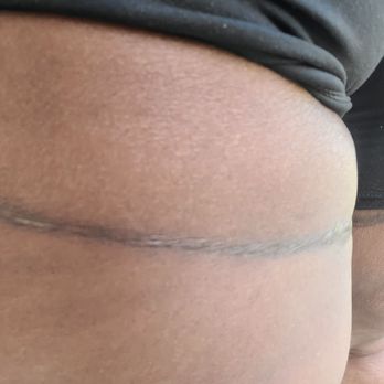 Regional Plastic Surgery Center - After 3 years and still hideous - Plastic Surgeons Near Me - Richardson, Texas