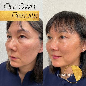 Lumera Regenerative Medicine - Sculptra treatment before and after results. - Medical Spas Near Me - Tualatin, Oregon Lumera Regenerative Medicine - Sculptra treatment before and after results. - Medical Spas Near Me - Tualatin, Oregon