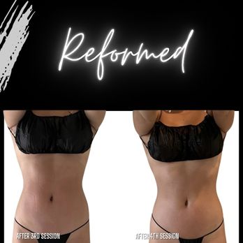 Reformed - Body Contouring Near Me - El Cerrito, California Reformed - Body Contouring Near Me - El Cerrito, California