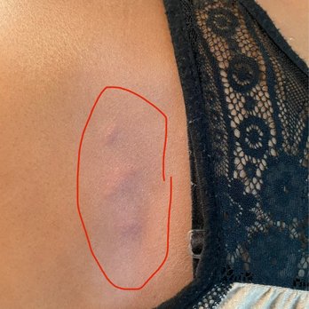 Florida Vacation Homes - Bed bug bites - Vacation Rentals Near Me - Davenport, Florida