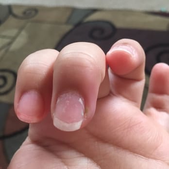 Fun Nails & Spa - Infection on right-side of nail. - Nail Salons Near Me - Ontario, California Fun Nails & Spa - Infection on right-side of nail. - Nail Salons Near Me - Ontario, California