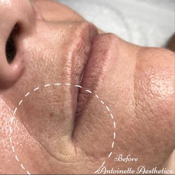 Antoinette Aesthetics - Before HydraFacial - Skin Care Near Me - Glendora, California