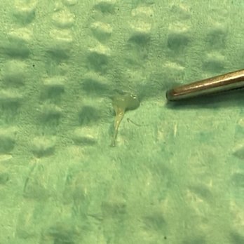 Howard E Ong, DDS - My pulp from my tooth - dr Ong got it out in 1 piece - General Dentistry Near Me - Seal Beach, California Howard E Ong, DDS - My pulp from my tooth - dr Ong got it out in 1 piece - General Dentistry Near Me - Seal Beach, California