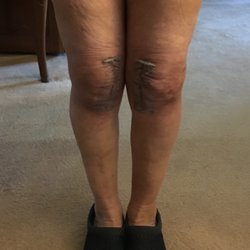 Dearborn & Associates Institute for Joint Restoration - Post bilateral knee replacement surgery by Dr. Dearborn.
