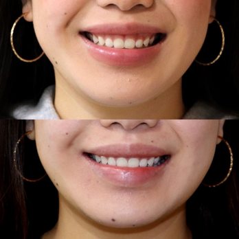 La Belle Vie MedSpa - Botox for Gummy Smile - Medical Spas Near Me - Tukwila, Washington La Belle Vie MedSpa - Botox for Gummy Smile - Medical Spas Near Me - Tukwila, Washington