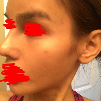 Advanced Aesthetics - 2nd pics side view (right after dissolving the filler) - Medical Spas Near Me - Las Vegas, Nevada Advanced Aesthetics - 2nd pics side view (right after dissolving the filler) - Medical Spas Near Me - Las Vegas, Nevada