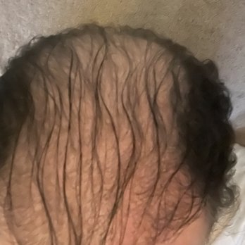 Hairline Designs - Before SMP - Hair Loss Centers Near Me - Wilton Manors, Florida Hairline Designs - Before SMP - Hair Loss Centers Near Me - Wilton Manors, Florida