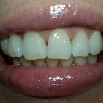 Peter Do DDS - Escondido Dentist, Implant Dentist - Before picture of anterior bonding - Cosmetic Dentists Near Me - Escondido, California Peter Do DDS - Escondido Dentist, Implant Dentist - Before picture of anterior bonding - Cosmetic Dentists Near Me - Escondido, California