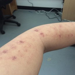 Burn marks from laser hair removal treatment at Clearstone Spa. Burn marks from laser hair removal treatment at Clearstone Spa.