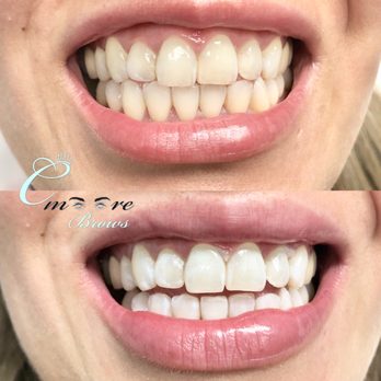 C. Moore Brows Permanent Cosmetics - Before & After Extreme Teeth Whitening - Eyebrow Services Near Me - Hackensack, New Jersey