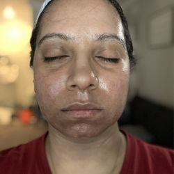 Ultimate Image MedSpa - After the E-Matrix session. Expect burning sensation.