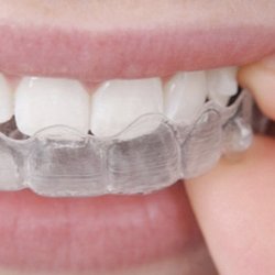 Lewis Orthodontics Edmond - Clear Aligners