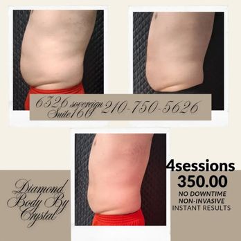 Diamond Body Contouring - Body Contouring Near Me - San Antonio, Texas Diamond Body Contouring - Body Contouring Near Me - San Antonio, Texas