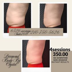 Diamond Body Contouring