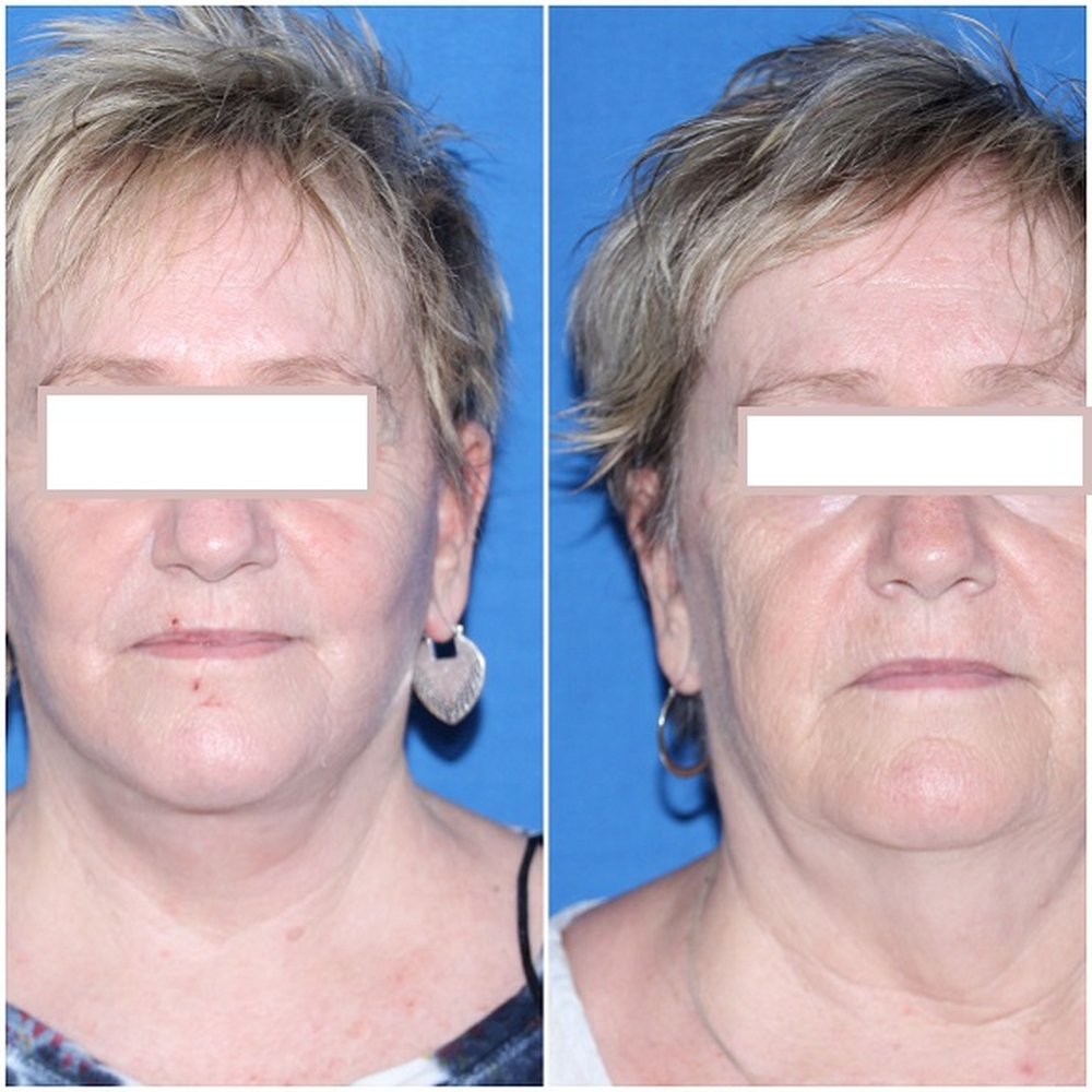 Iconic Plastic Surgery - After (left), before (right). - Cosmetic Surgeons Near Me - Carlsbad, California Iconic Plastic Surgery - After (left), before (right). - Cosmetic Surgeons Near Me - Carlsbad, California