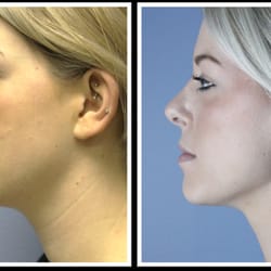 Vargas Face and Skin Center - Procedure: Laser Lipo - Neck

Actual patient of Dr. Hannah Vargas