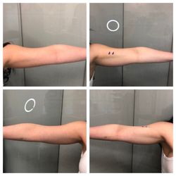 Evolve Body Sculpting - This client was treated with 3 modalities; I-Lipo, Ultrasonic Cavitation, & Therma-Lift. These are amazing results after just ONE treatment!