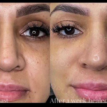 Fibroplasmabeauty - Fibroblast Upper/lower eye area Lip flip - Permanent Makeup Near Me - Pleasant hill , California Fibroplasmabeauty - Fibroblast Upper/lower eye area Lip flip - Permanent Makeup Near Me - Pleasant hill , California