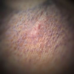 Zen Ink 610 Tattoo - Another scar from his tattoo.