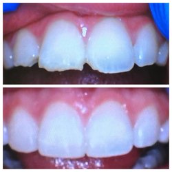 Perfect Smiles Family Dentistry - Chipped front teeth from accidental fall. Restored with composite bonding.