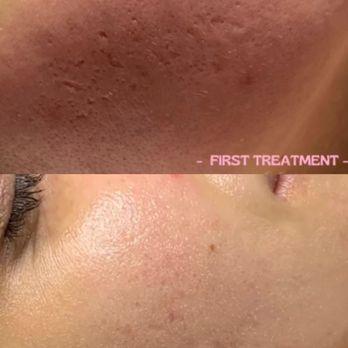 Skin by Meg - Before & After CIT. - Estheticians Near Me - Glendale, California Skin by Meg - Before & After CIT. - Estheticians Near Me - Glendale, California