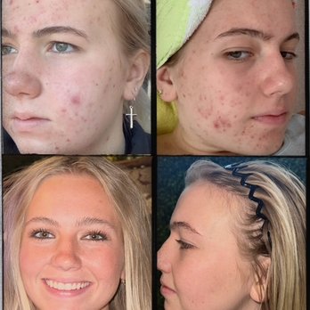 Timeless Aesthetics & Wellness - Bye bye acne and Scarring!! - Laser Hair Removal Near Me - Cumming, Georgia Timeless Aesthetics & Wellness - Bye bye acne and Scarring!! - Laser Hair Removal Near Me - Cumming, Georgia