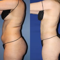 Premier Cosmetic Surgery & Medispa - VASER Lipo: Abdomen & Hips