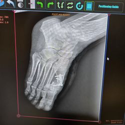 Vincenzo Palmieri, DPM - A fixed bonion with screws