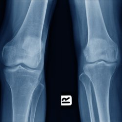 Arthritis Knee Pain Centers Pineville