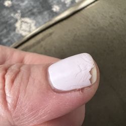 Navi Nails Spa - Cuticle nail infection