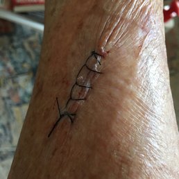 Just had some cancer removed they did a Great job! Every organized , very impressed! I recommend Just had some cancer removed they did a Great job! Every organized , very impressed! I recommend