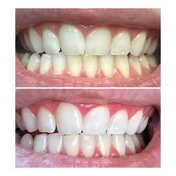 The Jaw Dropper - Before and after - Teeth Whitening Near Me The Jaw Dropper - Before and after - Teeth Whitening Near Me