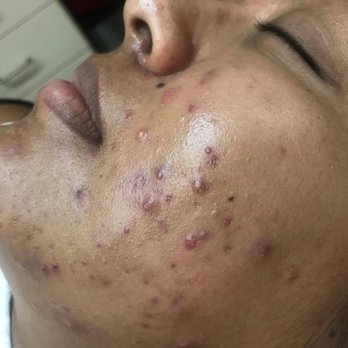 Acne Solutions Skin Care & Spa - Acne Treatment Near Me - Upland, California