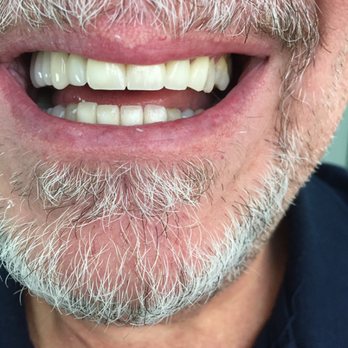 Maxi Dental Group - Cambio de Línea de Sonrisa con coronas en zirconia porcelana - General Dentistry Near Me - Tijuana, BCN Maxi Dental Group - Cambio de Línea de Sonrisa con coronas en zirconia porcelana - General Dentistry Near Me - Tijuana, BCN