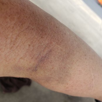 BioLife Plasma Services - Of my right arm, vein and surrounding area 4 days after Hematoma - Blood & Plasma Donation Centers Near Me - San Antonio, Texas BioLife Plasma Services - Of my right arm, vein and surrounding area 4 days after Hematoma - Blood & Plasma Donation Centers Near Me - San Antonio, Texas