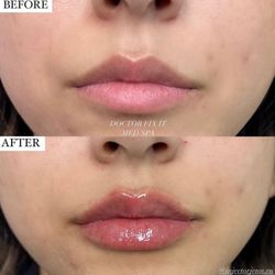 Fixation Med Spa - Lip Filler