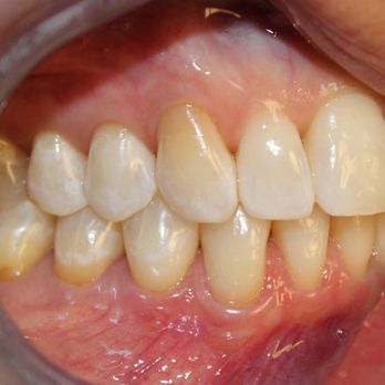 Bon DDS Dental Studio - Internal whitening before - Cosmetic Dentists Near Me - St. Charles, Illinois
