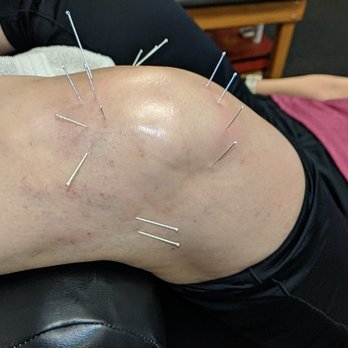 Ignite Physical Therapy - Needling. - Physical Therapy Near Me - Chandler, Arizona