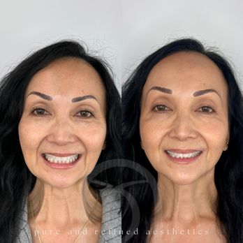 The Laser Image - Lower Face Tox: Nefertiti and Lip Flip by Winnie at PARA - Skin Care Near Me - Redondo Beach, California The Laser Image - Lower Face Tox: Nefertiti and Lip Flip by Winnie at PARA - Skin Care Near Me - Redondo Beach, California