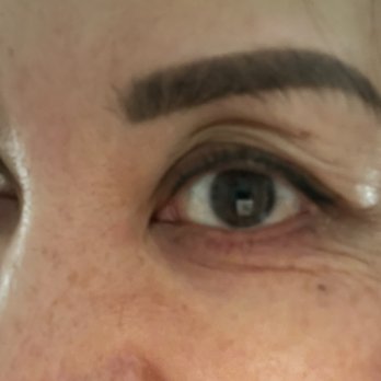 Sheena Kong, MD - Pic here on the middle has more folds which I don't have before , look worst - Cosmetic Surgeons Near Me - San Francisco, California Sheena Kong, MD - Pic here on the middle has more folds which I don't have before , look worst - Cosmetic Surgeons Near Me - San Francisco, California