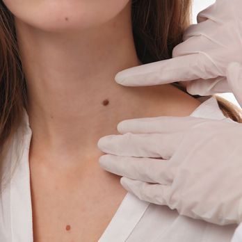 Mole Removal Temecula - Mole Removal Temecula - Medical Centers Near Me - Temecula, California Mole Removal Temecula - Mole Removal Temecula - Medical Centers Near Me - Temecula, California