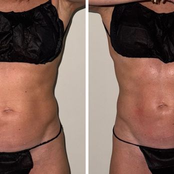 DreamBody Lux Med Spa - After 1 session! - Body Contouring Near Me - Naples, Florida DreamBody Lux Med Spa - After 1 session! - Body Contouring Near Me - Naples, Florida