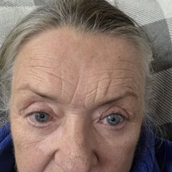 Gallo & Cho - My eyes after surgery.
