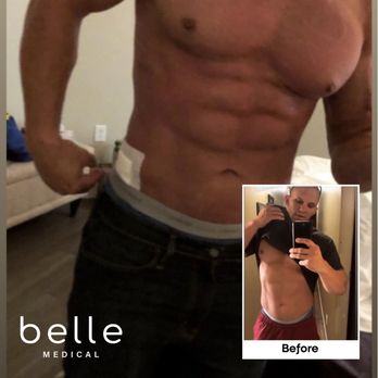 BelleSculpt - RJ Best
HD Body Sculpting, Love Handles

https://www.bellemedical.com/results/my-belle-story/ - Medical Spas Near Me - Draper, Utah
