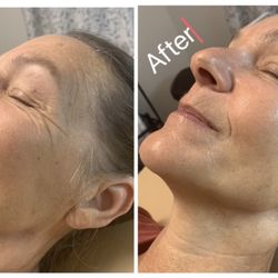 Powerhouse Hydro Dermabrasion with an infusion of biologically active peptides for smoother, firmer, and more radiant skin.