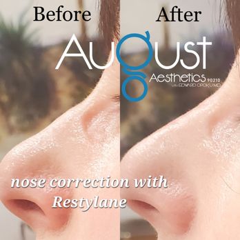 August Aesthetics - nose filler before and after - Aestheticians Near Me - Beverly Hills, California August Aesthetics - nose filler before and after - Aestheticians Near Me - Beverly Hills, California
