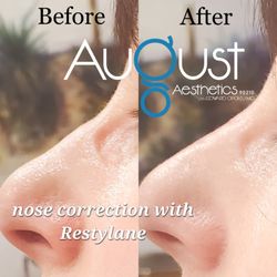 August Aesthetics - Nose filler before and after