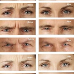 Reflection Medical Spa - Botox Injections Cincinnati OH