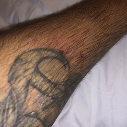 Spider bite.